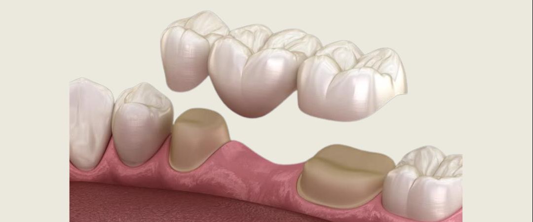 Ilustrație: punte dentară sprijinită pe doi dinți vecini